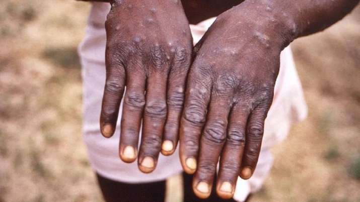 Monkeypox Now a Global Health Emergency Says W H O - 68